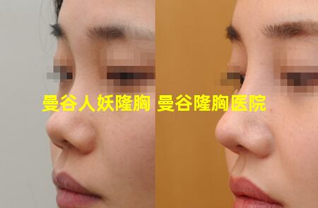 曼谷人妖隆胸 曼谷隆胸医院